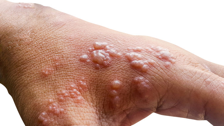 Skin infected Herpes zoster virus on the arms